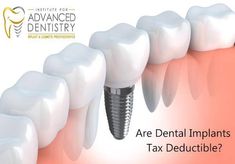 Dental Bridge Cost, Implant Dentist, Best Dental Implants, Dental Implant Surgery, Dental Implants Cost, Implant Dentistry, Teeth Implants, Dental Bridge, Tooth Extraction