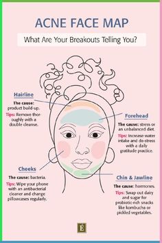 There is more to breakouts than meets the eye - and where they appear on your face can be the key to clear skin. Find out the meaning of pimples on your face - the first step in discovering how to get rid of blackheads, whiteheads, blemishes and textured skin. Click to read your guide to using an acne face map (or acne chart) to decode what your breakouts are telling you. 📌 how to get rid of breakouts, get rid of frown lines, removes dark spots 🌸 #selfcare #brightening #moisturizing Pimple Chart, Face Acne Remedies, Acne Chart, Acne Face Map, Food For Acne, Blind Pimple, Forehead Acne