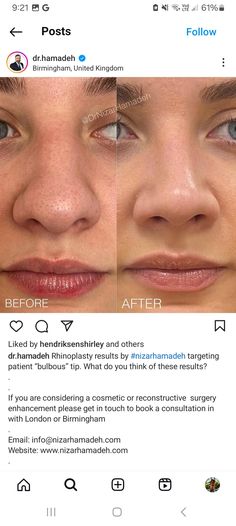 Small Nose Job, Wide Bridge Nose Rhinoplasty, Nostril Reduction Before And After, Bulbous Nose Job, Fox Eye Lift Surgery, Nose Job Before And After Front View, Button Nose Nose Job, Nose Job Natural, Thick Skin Rhinoplasty