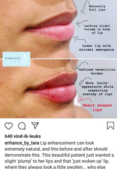 Lip Filler Minimal, Rich Ridges Lips, Lip Filler For Oval Face, Natural Top Lip Filler, Light Lip Injections, Super Natural Lip Filler, Russian Pout Lips, Lip Contouring Filler, Bigger Top Lip Filler