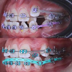 Dentist Career, Orthodontics Teeth, Braces Tips, Dental Fillings, Braces Colors, Dental Facts, Dental Braces, Orthodontics Braces, Teeth Braces