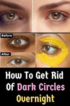 I used turmeric eye mask and got rid of dark circles in 7 days to remove eye wrinkles and bags under the eyes How to permanently treat / eliminate dark circles under the eyes, with this simple ingredient. turmeric eye mask to remove dark circles #Dark_Circles #dark_circles #under_eye_circles #dark_eye_circles #eye_dark_circles #eye_circles #dark_circles_treatment #dark_circles_mask #remove_dark_circles #dark_circles_cream #undereye_dark_circles Dark Circle Remedies Overnight, Remove Eye Wrinkles, Dark Circle Remedies, Dark Circles Around Eyes, Dark Eye Circles, Health Ideas, Dark Circles Under Eyes, Reduce Dark Circles