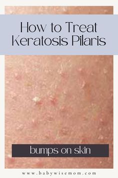 Simple things you can do to help treat your keratosis pilaris and get healthier skin! Help get rid of those pesky bumps White Bumps On Skin, Red Spots On Face, Bumps On Legs, Bumps On Skin, Bumps On Arms, Red Skin Spots, Cherry Angioma, What Causes Pimples, Skin Tone Colors