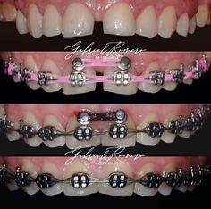 Dental Videos, Beaded Bracelets