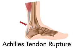 Achilles Tendon Repair Rehab Protocol + Recovery Time Frame Torn Achilles Recovery, Achilles Recovery, Achilles Rupture Recovery, Achilles Tendinopathy Exercises, Insertional Achilles Tendinopathy, Achilles Tendon Ruptures, Achilles Tendinopathy, Achilles Pain, Achilles Tendon