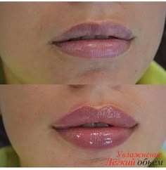 Lip Injections Juvederm, Lips Fillers, Lips Shape, Aesthetic Dermatology, Hair Salon Interior