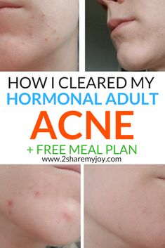 Hormonal Acne Diet Plan (best 7-day clear skin meal plan) - 2SHAREMYJOY Acne Meal Plan, Acne Diet Plan, Hormonal Acne Diet, Cucumber Diet, Get Rid Of Acne, Rid Of Acne