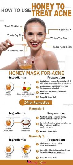 Tips Kecantikan, Diy Apothecary, Honey For Acne, Pimples Overnight, Honey Mask, Honey Face, Acne Scar, Treat Acne, Acne Care