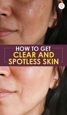 How To Help Breakouts Clear Skin, How To Get Clear Even Tone Skin, Smoother Face Skin Care, Best Tips For Clear Skin, How To Get Spotless Clear Skin, Improve Skin Texture Naturally, How To Clean Face Clear Skin, Secret To Clear Skin, How To Clean Skin