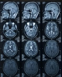 an mri scan shows multiple areas of the brain