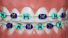 September Braces Colors, Cool Braces Colors Ideas Colour, Cute Braces Colors Combinations, Braces Combination Colors, Summer Braces Colors, Braces Colors Aesthetic, Brace Colors, Braces For Kids, Braces Colours