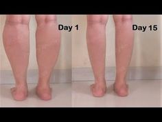 before and after pictures of varicous on legs, showing the different stages of varicous