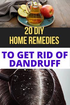 How To Get Ride Of Dandruff Fast At Home, How To Avoid Dandruff, Dandruff Home Remedies, Dry Scalp Remedy, Hair Growth Mask Diy, Home Remedies For Dandruff, How To Treat Dandruff, Rid Of Dandruff, Diy Haircare