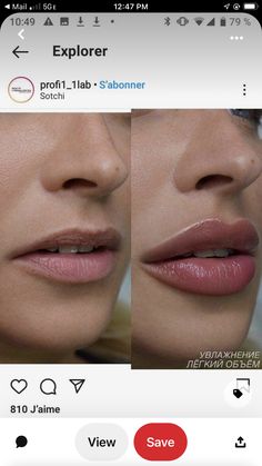 Lip Goals Filler, Lip Filler For Hydration, Downturned Lips Filler, Lip Filler Inspo Heart Shape, .5ml Vs 1ml Lip Filler, Lip Filler Shape Ideas 1ml, Bow Shaped Lip Filler, Lip Filler 1 Syringe, Heart Shaped Lip Filler