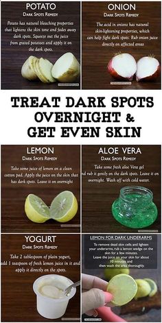 Pin on Some Acne Scar Tips Dark Spots Remedies, Fresh Aloe Vera Gel, Black Heads, Resep Diet, Beauty Tips For Glowing Skin, Cold Remedies