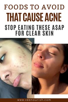 Foods to Avoid for Clear Skin: Acne Prevention Tips How To Clear My Face From Acne, Pimple Clearing Tips, Tips To Reduce Acne, How To Get Clear Skin For Oily Skin, How To Get Healthier Skin, Healthy Snacks For Acne, Anti Acne Recipes, Clearing Up Acne, Acne Prone Skin Tips