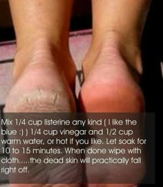 Homemade dead skin remover. Need to try it sometime!!! Cracked Skin, Beauty Remedies, Skin Remedies, Keeping Healthy, Health And Beauty Tips, Skin Tips, Beauty Treatments, Diy Beauty, Dead Skin