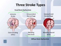 Types Of Strokes Nursing, Types Of Strokes, Cardiac Nursing