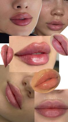 Lip Fillers