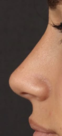 Perfect Nose Rhinoplasty, Nose Rhinoplasty, Nose Plastic Surgery, Nose Surgery Rhinoplasty, Nose Fillers, Nose Jobs, Rhinoplasty Nose Jobs, Nose Reshaping, Botox Lips