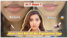 Hai Guys ,In today’s video I’ll be sharing how to get rid of DARK and PIGMENTED lips naturally and also with some BEAUTY products quickly. I’ll also be shari... How To Makeup, Baby Sleep Schedule, After Pictures, Before And After Pictures, S Video, Beauty Products