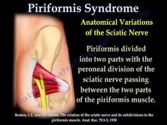 How to Fix Piriformis Syndrome - YouTube Exercises For Piriformis Syndrome, Si Exercises, Sacroiliitis Exercises, Sacro Illiac Stretch, Pregnancy Sciatica Stretches, Video Style, Sciatica Pain Relief Pregnancy, Pinched Nerve