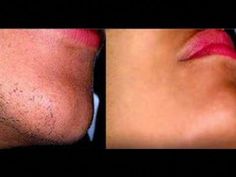 Home Remedies to Remove Facial Hair PermanentlyFacial Hair is one of the most annoying problems among females. There are number of methods that treats extra ... Remove Facial Hair Permanently, Razor Bumps Remedy, Natural Facial Hair Removal