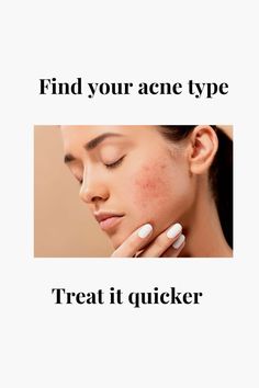 Find what type of acne you have instead of popping those pimples and getting scars #acnetreatment #acnetips #acne #acnescarsproducts #acneproneskin #pimple #pimplesremedies #pimpleproblems #acnefighter Pimples Remedies, Types Of Acne, What Type, Acne Prone Skin, Make Your Day, Acne, Finding Yourself