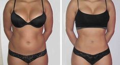 Vaser Lipo, Smart Lipo, Detox Plan, Cool Sculpting, Compression Garment