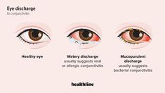 Bacterial conjunctivitis often causes a mucopurulent discharge. Learn what that means, when to contact a doctor, and how to treat it. Yoga Information, Heart Diet, Eye Pain, Cells And Tissues, Baby Sleep Schedule, Blurry Vision, Unwanted Facial Hair, Light Sensitivity, Bacterial Infection