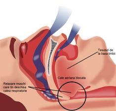 Sleep Apnea is a disorder that affects millions of Americans. We work with several renowned specialists to help treat this disorder. Natural Remedies For Sleep, Trying To Sleep, Sleep Routine, Trouble Sleeping