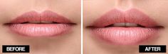 How To Plump Lips At Home, How To Plump Lips Naturally, Natural Plump Lips How To Get, How To Plump Your Lips Naturally, Natural Ways To Plump Lips, Cosmetic Clinic, Cinnamon Oil