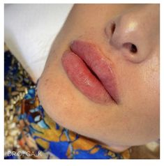 Natural Full Lip Filler, Lip Filler Shape Ideas, Russian Lip Filler, Juvederm Lips, Rhinestone Makeup