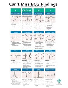 Medische Humor, Cardiology Nursing, Paramedic School, Nursing Mnemonics, Cardiac Nursing, Critical Care Nursing