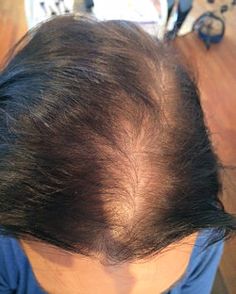 Intralace Gallery - before and after Intralace System hair loss treatment Plump Hair, Before And After Haircut, Hair Toupee, Bald Spot