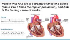 What Is Paroxysmal Atrial Fibrillation Symptoms And Treatment Atrial Fibrillation Symptoms, Normal Sinus Rhythm, Heart Rhythm, Pet Scan, Gastrointestinal System, Normal Heart, Anatomy Physiology, Atrial Fibrillation, Heart Rhythms