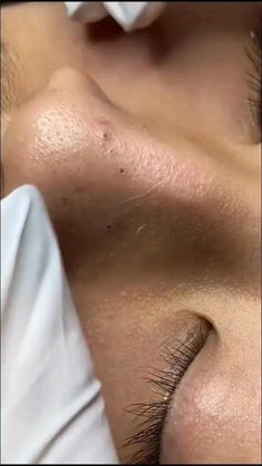 Black Head Removal Video Nose, Black Heads Removal Video, Blind Pimple, Healthy Skin Care Routine, Zit Popping Videos, Pimples Remedies, Prevent Pimples, How To Get Rid Of Pimples, Natural Sleep Remedies