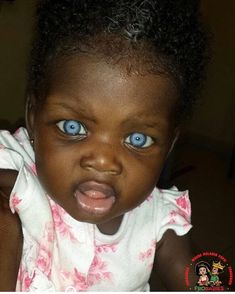 Waardenburg Syndrome, Grand Rising, Rare Eyes, Different Colored Eyes, Charming Eyes, Baby Eyes