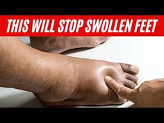 Swelling Feet Remedies, Sore Feet Remedies, Swelling Remedies, Back Pain Remedies, Swollen Legs, Home Health Remedies