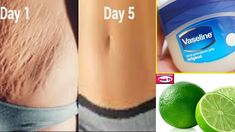 Remove Strech Mark, Vaseline Uses For Breast, Strechmark Remover Skin Care, How To Remove Strechmark, Stretchmark Remover, Strech Marks Removal, Stretch Mark Removal Cream, Strech Marks, Vaseline Uses