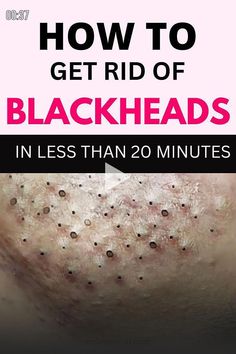 Remedies For Blackheads, Landscaping Hacks, Blackheads On Face, Blackhead Remedies, Blackheads On Nose, Rid Of Blackheads, Blackheads Removal, How To Get Rid Of Pimples, Skin Color Palette