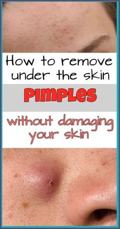 How to Remove Under the Skin Pimpl by ruth Taylor | This newsletter was created with Smore, an online tool for creating beautiful newsletters for educators, nonprofits, businesses and more Under The Skin Pimples, Remove Skin Tags Naturally, Under The Skin, Acne Cream, Skin Care Cream, Healthy Beauty