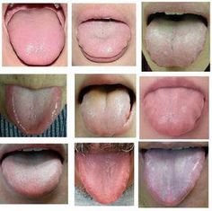 Examination through inspection entails the physician using visual senses to investigate a patient Tongue Cracks Meaning, Bumps On Tongue, Tongue Mapping Health, Tongue Problems, Chinese Tongue Diagnosis, What Does Your Tongue Tell You About Your Health, Skin Moles