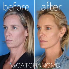 Jawline Contour, Mid Face Lift, Neck Lift Surgery, Mini Face Lift, Botox Brow Lift, Forehead Lift, Facial Procedure, Beauty Transformation, Face Lift Surgery