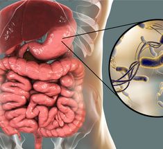 H Pylori Symptoms, Parasite Cleanse, Too Much Estrogen, Candida Albicans, Stomach Ulcers, Acid Reflux, Signs And Symptoms, Holistic Approach