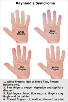 Reynauds syndrome can be a sign of hypothyroidism. My niece has been admitted to the hospital   has tentatively been diagnosed with with this condition. A stress test tomorrow will help determine the final diagnosis. Please pray for Erin. Reynauds Syndrome, Blue Fingers, Invisible Illness, Autoimmune Disease, Relationship Advice, Thing 1