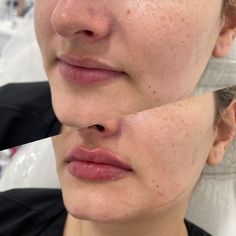 Lip filler Moisturized Lips Aesthetic, Lips Botox Natural, Natural Plump Lips Aesthetic, Plump Lips Naturally Aesthetic, Clear Glossy Lips Aesthetic, Face Lift Surgery, Acne Treatments, Owensboro Ky, Cosmetic Injectables