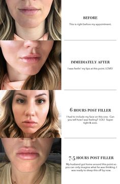 Light Lip Filler Before And After, 1.5 Lip Filler, Getting Lip Fillers, Lip Filler Facts, Lip Filler Transformation, Hyaluronic Lip Fillers, Full Syringe Lip Filler, 1ml Lip Filler Small Lips, Lip Flip With Filler