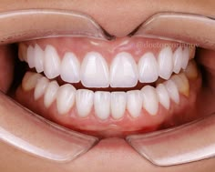 Beautiful Smile Aesthetic, Dental Morphology, Smile Aesthetic, Healthy Gums, Teeth Shape