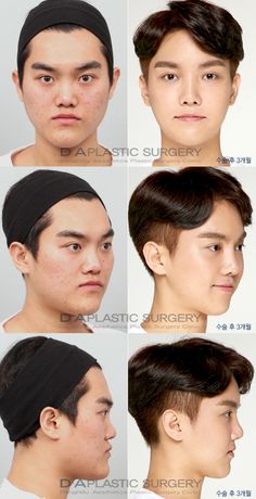 Male Transformation, Aesthetic Facial, Nose Plastic Surgery, Face Symmetry, Korean Show, Head Reference, Rhinoplasty Nose Jobs, Head Anatomy, Facial Contouring